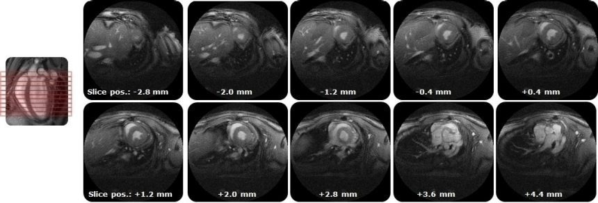 IntraGateUTE with its radial readout enables high quality cardiac cine data in shortest measurement time.