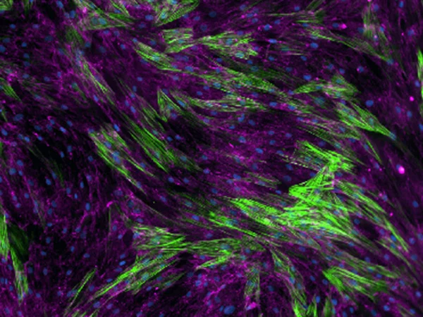 Fibroblast-to-myofibroblast (FMT) assay analyzed with ImageXpress® Confocal HT.ai High-Content Imaging System (Molecular Devices) showing extracellular collagen deposition (pink), alpha smooth muscle actin (green) and cell nuclei (blue)