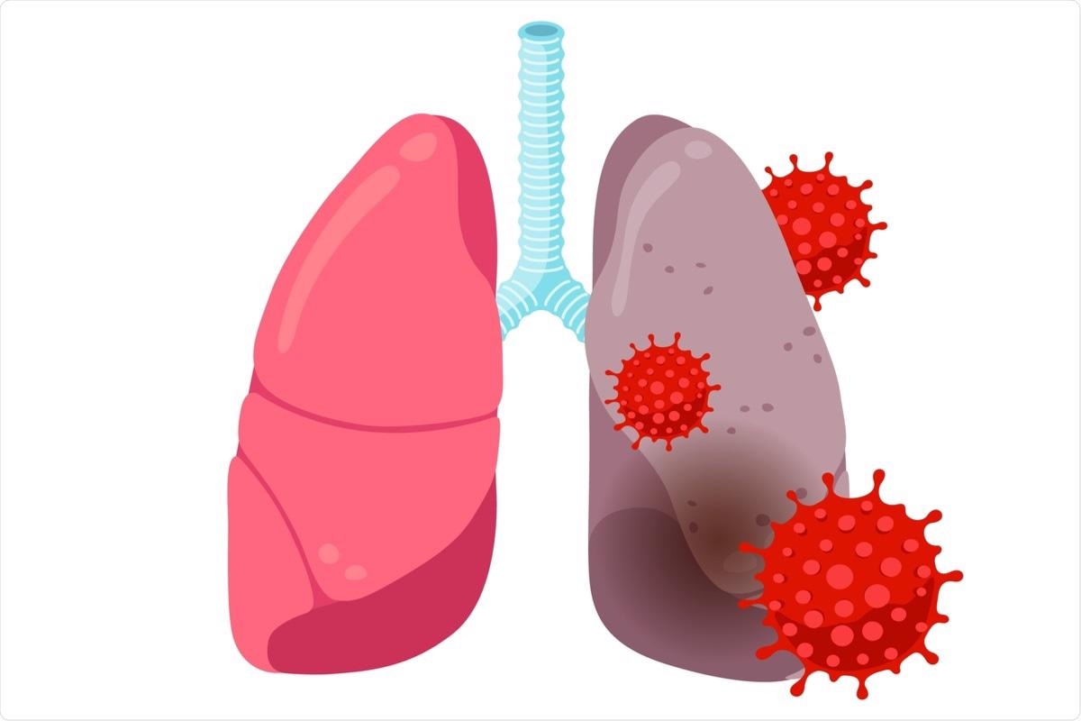 Study:  Inflammation in the COVID-19 Airway Is Due to Inhibition of CFTR Signaling by the SARS-Cov-2 Spike Protein. Image Credit: Azat Valeev / Shutterstock.com