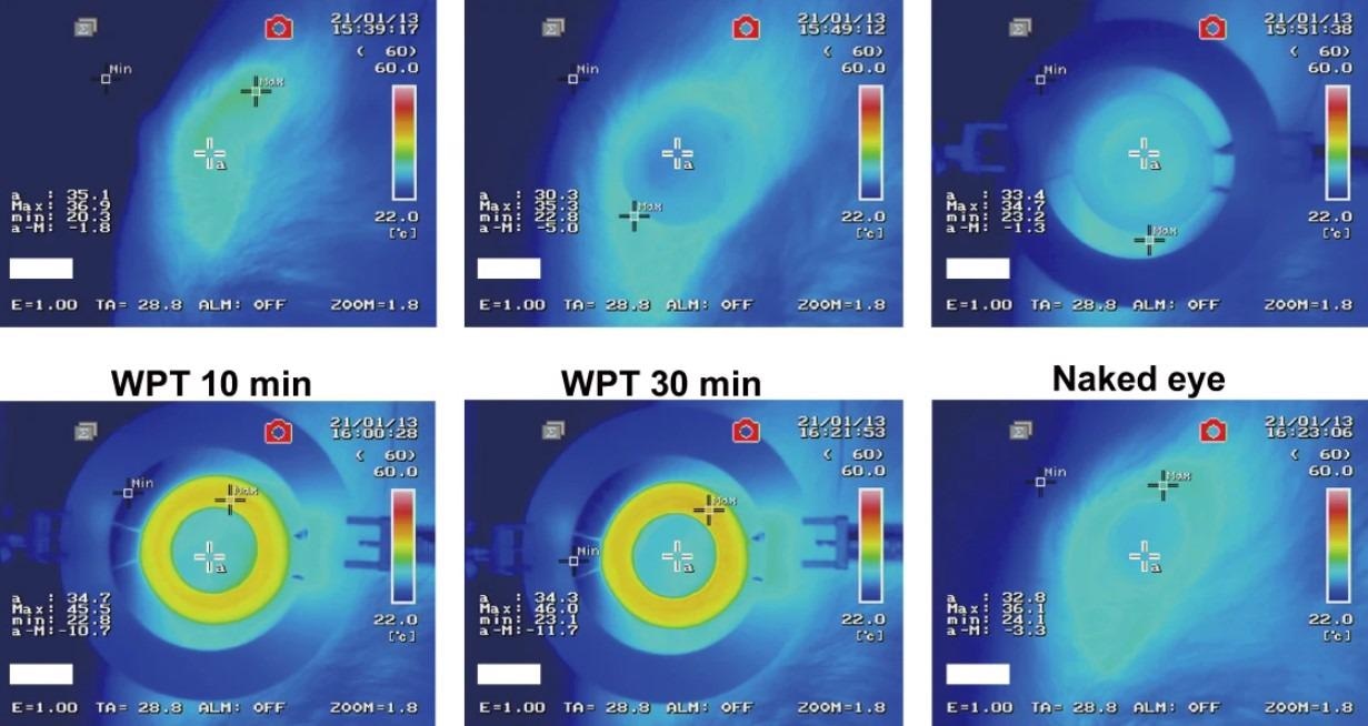 Study: Intelligent wireless theranostic contact lens for electrical sensing and regulation of intraocular pressure