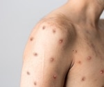 Study identifies two potential serological biomarkers of monkeypox infection
