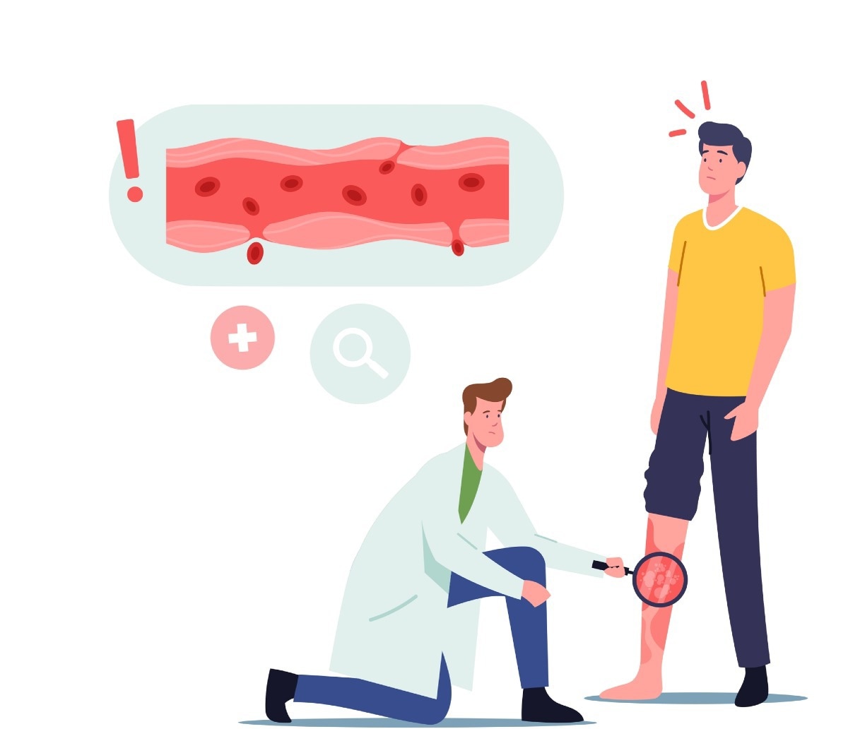 Study: Infection of SARS-COV2 as a trigger for IgA-associated vasculitis. Image Credit: ivector/Shutterstock