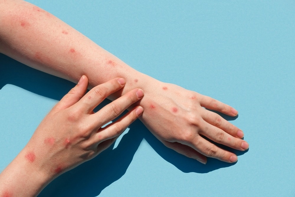 Study: Human monkeypox virus infection in an immunocompromised man: trial with tecovirimat. Image Credit: Marina Demidiuk/Shutterstock