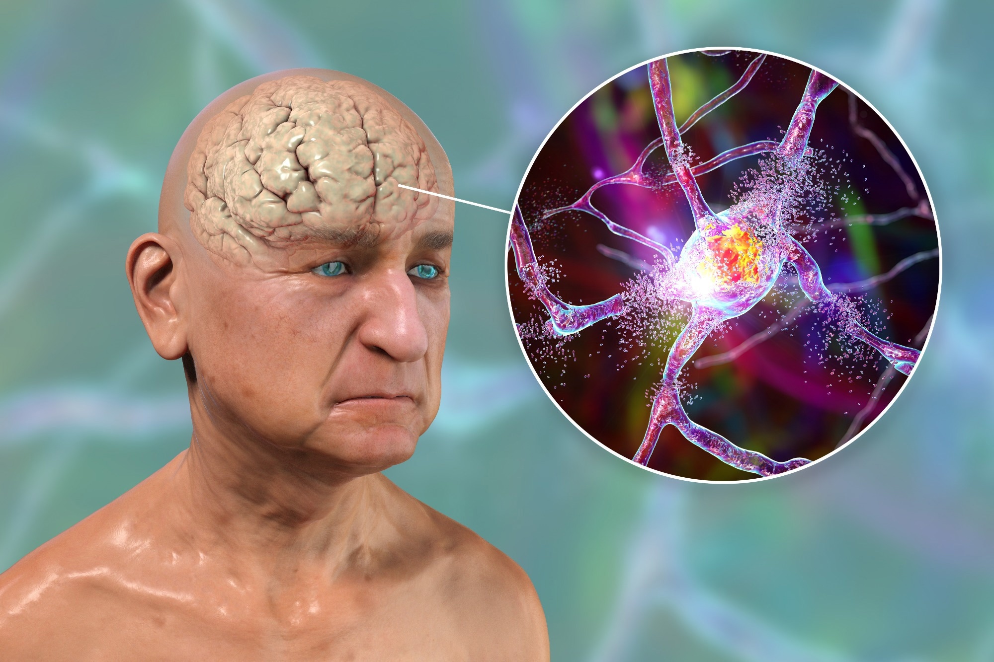 Study: Neuroinflammation: A Modifiable Pathway Linking Obesity, Alzheimer’s Disease, and Depression. Image Credit: Kateryna Kon / Shutterstock.com