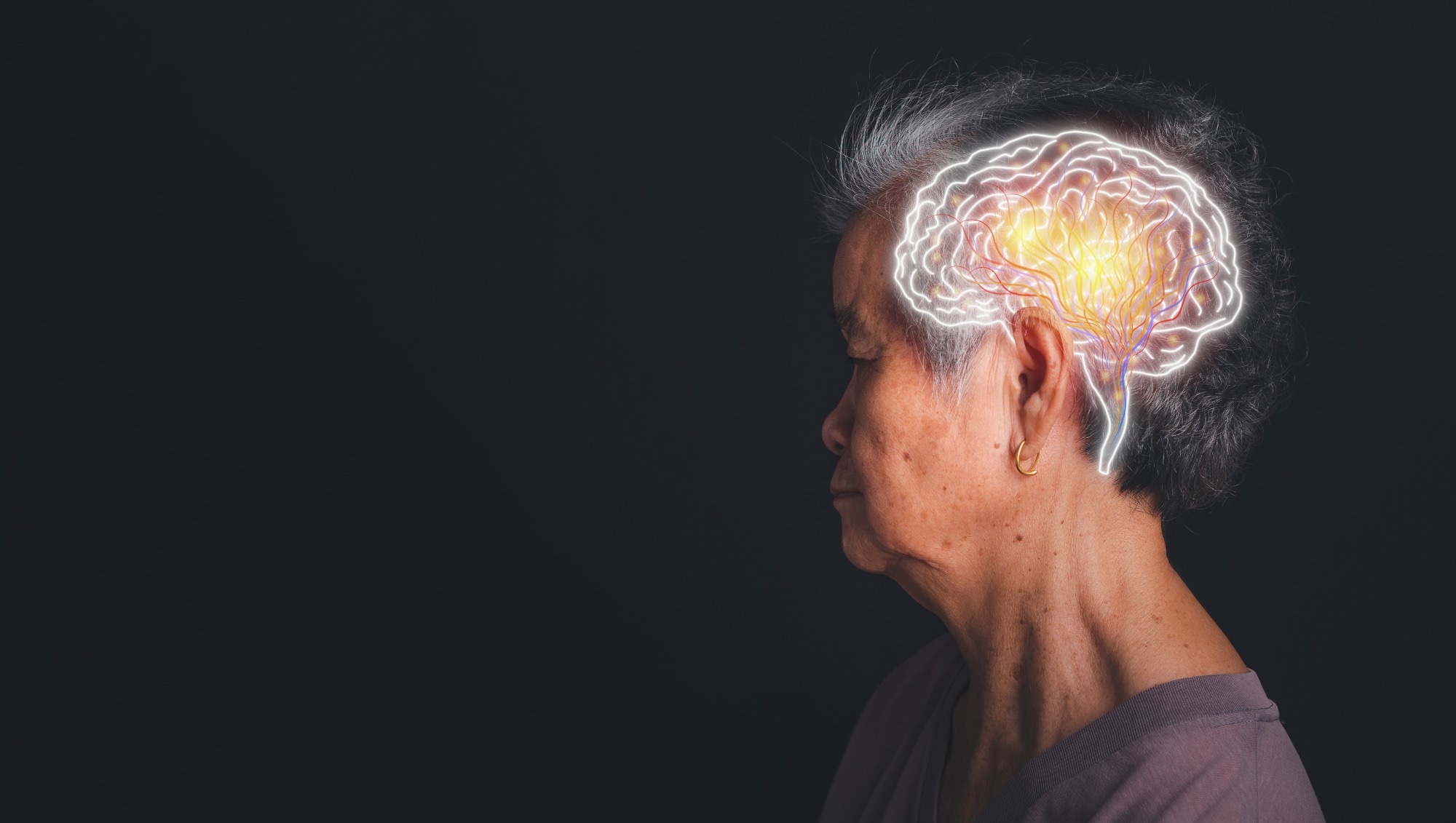 Study: Similar brain proteomic signatures in Alzheimer’s disease and epilepsy. Image Credit: meebonstudio / Shutterstock.com