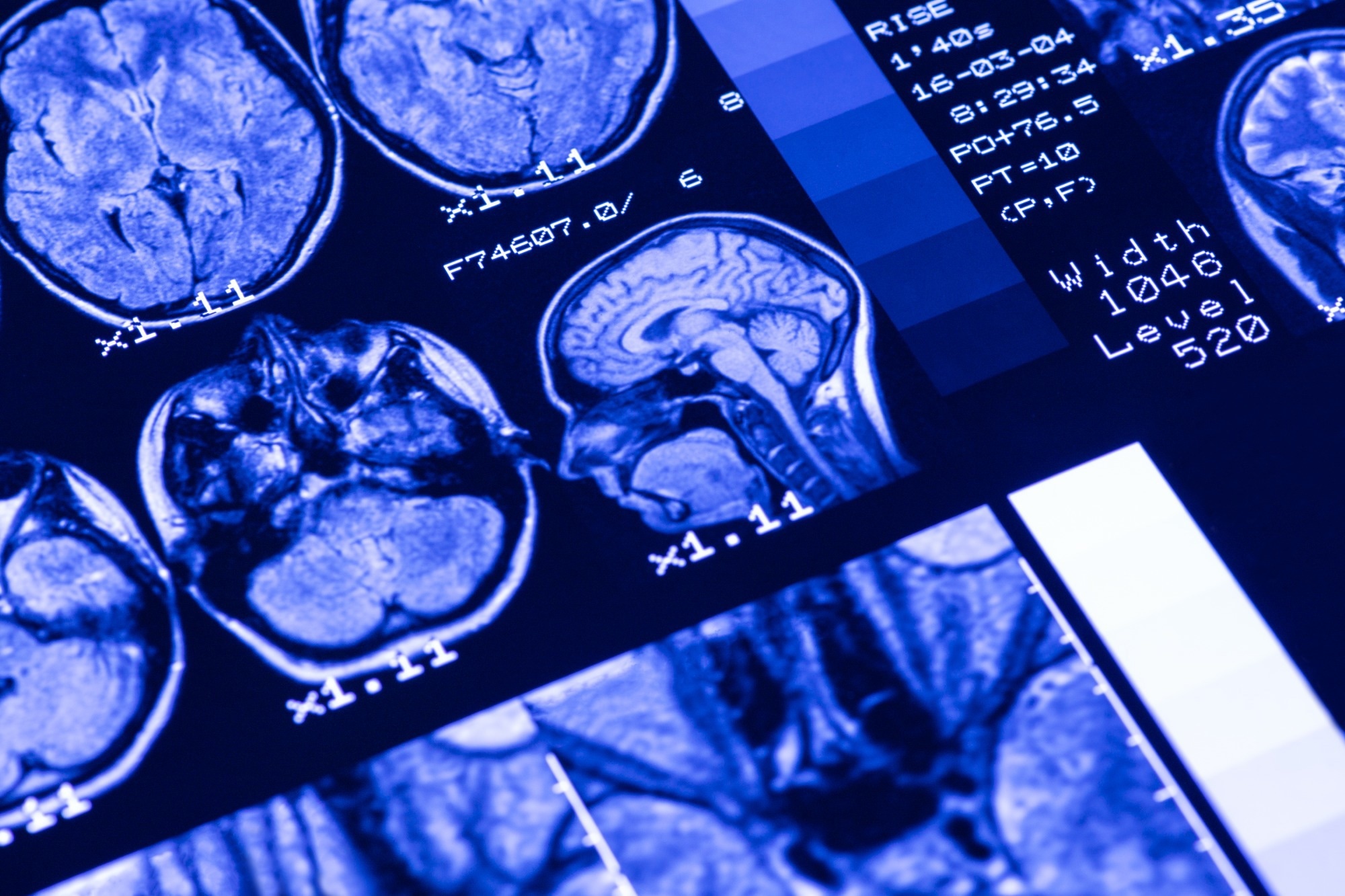 Study: ω-3 PUFA for Secondary Prevention of White Matter Lesions and Neuronal Integrity Breakdown in Older Adults: A Randomized Clinical Trial. Image Credit: Bk87 / Shutterstock.com