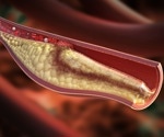 Alirocumab reduces dangerous coronary plaque and stabilizes high-risk lesions