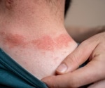 Iron retention in skin linked to psoriasis: Could hepcidin be the missing piece in treatment?