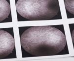 AI model analyzes retinal images to detect early Alzheimer’s disease and cognitive decline