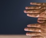 Vitiligo linked to increased risk of heart disease and stroke, study finds