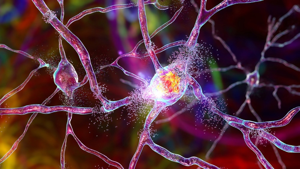 Study: Proteomimetic polymer blocks mitochondrial damage, rescues Huntington’s neurons, and slows onset of neuropathology in vivo. Image Credit: Kateryna Kon/Shutterstock.com