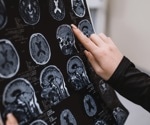 Portable MRI and AI improve Alzheimer’s diagnosis with cost-effective precision