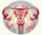 Endometriosis linked to higher cardiovascular disease risk