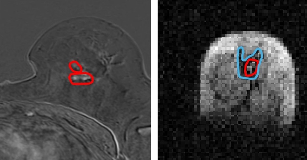 Groundbreaking scanner could revolutionize breast cancer diagnosis and treatment