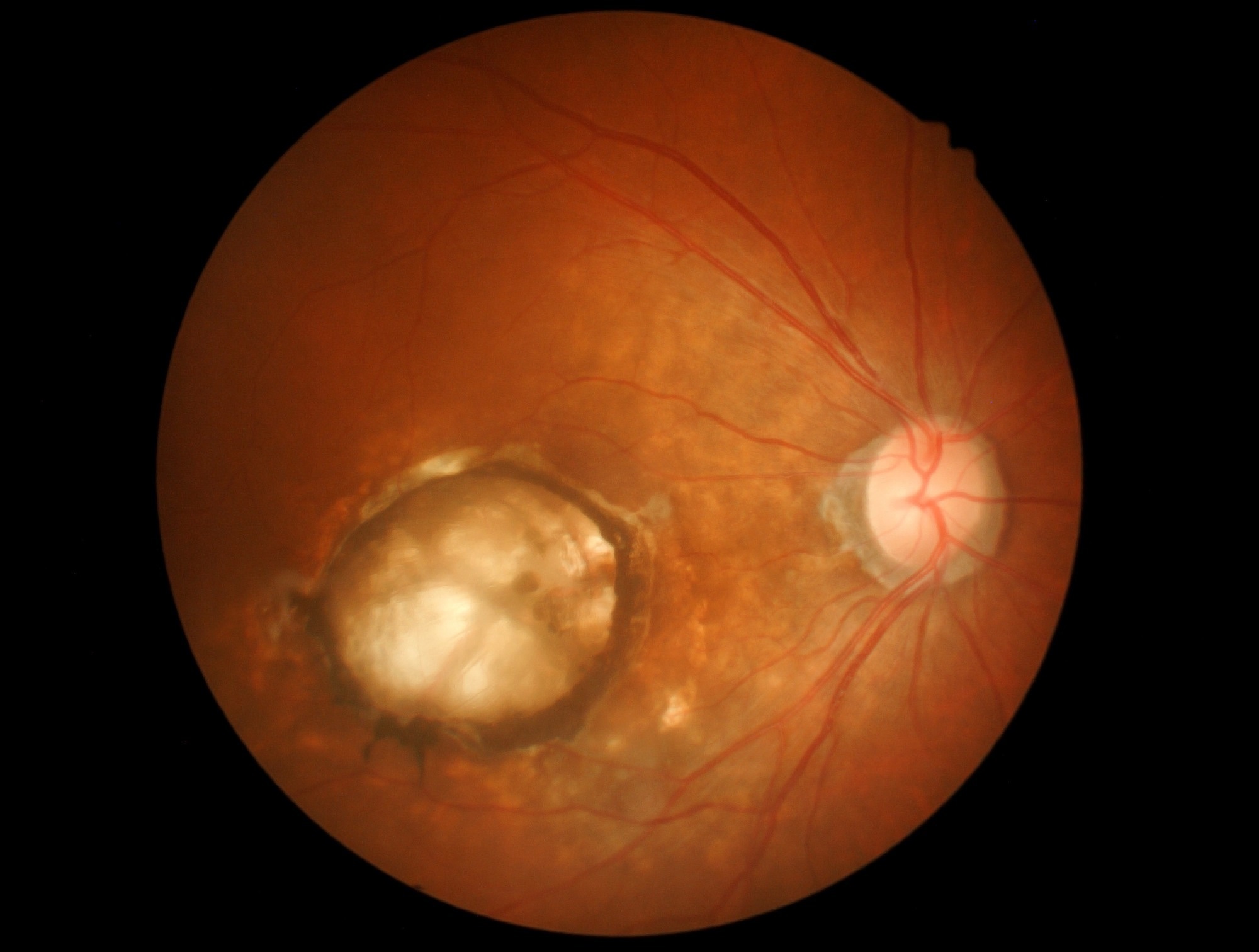 Study: Oral 8-aminoguanine against age-related retinal degeneration. Image Credit: memorisz / Shutterstock