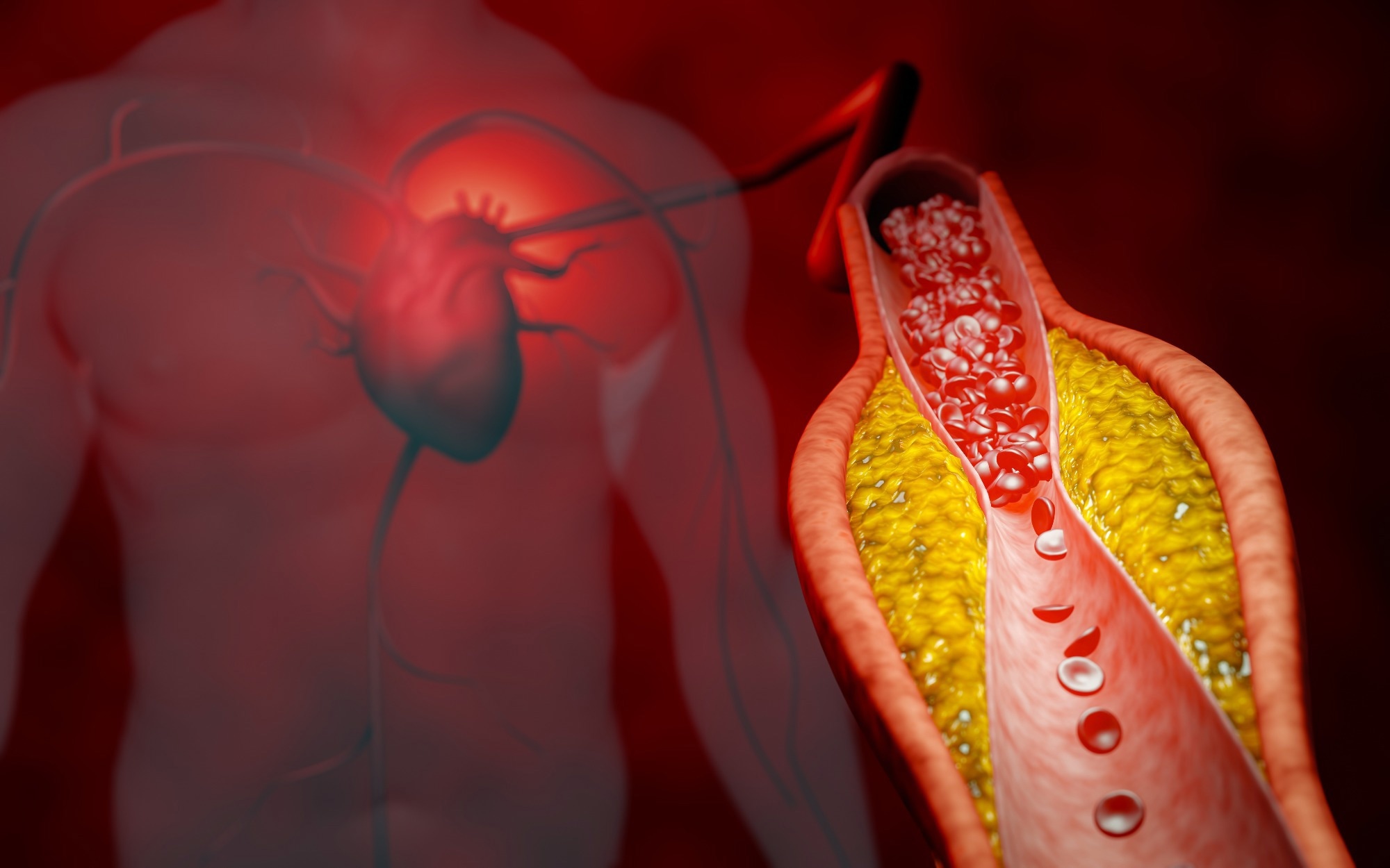 Study: Coronary Inflammation and Atherosclerosis by CCTA in Young Adults (aged 18-45). Image Credit: ridersuperone / Shutterstock