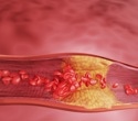Heart scan study reveals low-fiber diets drive dangerous heart plaques