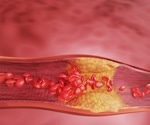 Heart scan study reveals low-fiber diets drive dangerous heart plaques
