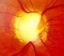 Research shows GLP-1 drugs safeguard vision despite small retinopathy risk