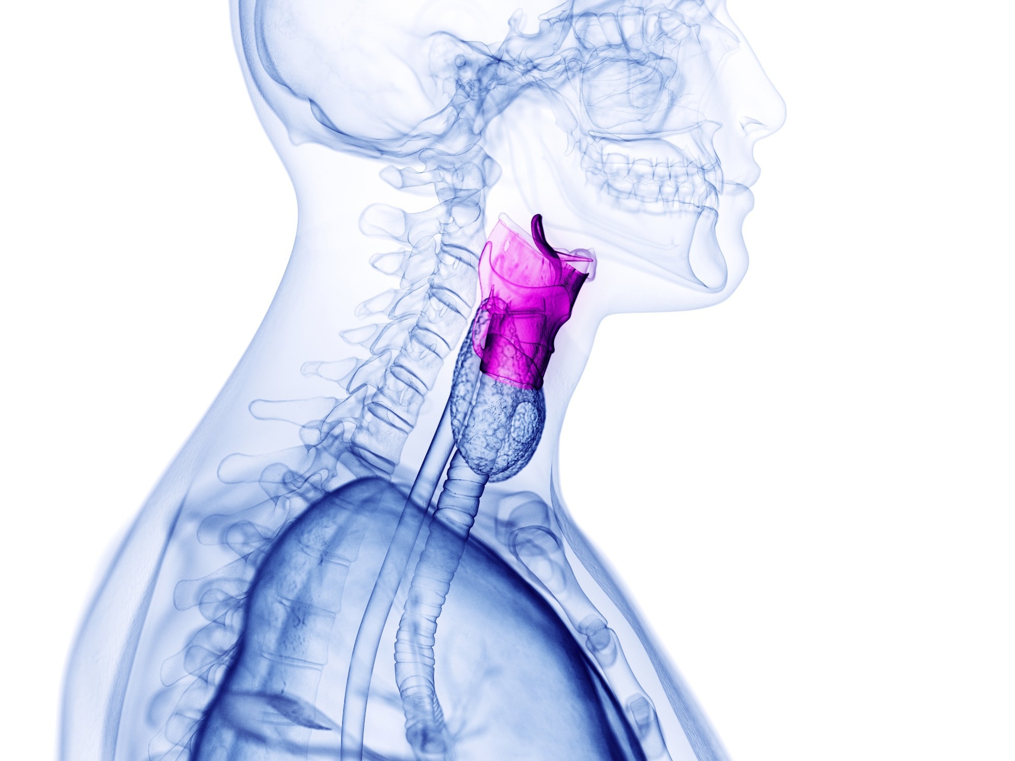 Study: Voice as a biomarker: exploratory analysis for benign and malignant vocal fold lesions. Image Credit: 3dMediSphere / Shutterstock