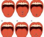 Do tongue piercings harm your oral health? Evidence points to yes