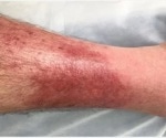Early dermatology consultation for presumptive cellulitis can improve outcomes, prevent misdiagnoses