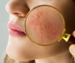 Psoriasis medications can treat more than the skin