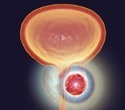 Discovery offers a breakthrough approach to combat prostate tumor growth