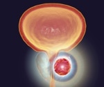 Study provides evidence for a causal genetic link between prostate cancer and urothelial carcinoma