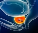 Breakthrough combo therapy lowers death risk in recurrent prostate cancer