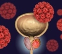 Breakthrough treatment for advanced prostate cancer could eliminate severe side effects