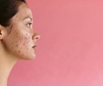 Pulsed dye laser therapy not effective in treating acne