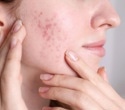 Study reveals widespread unrecognized acne among 35-year-old Finnish women