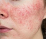 Study examines how often acne recurs after isotretinoin treatment