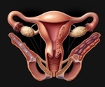 Previously overlooked hormone plays critical role in the development of endometriosis