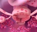New menstrual blood test detects endometriosis with five times greater sensitivity